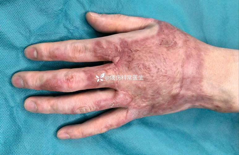 北京积水潭医院皮肤科